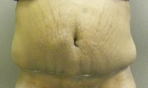 Panniculectomy After
