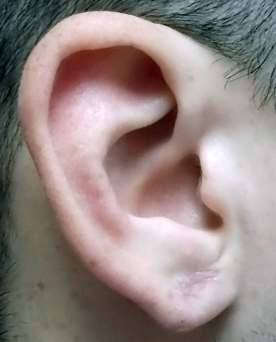 EXAMPLE 11 EAR GAUGE AFTER PICTURE Artistic Plastic